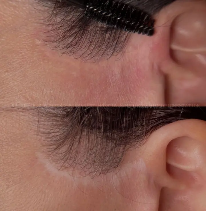Scar Camouflage example — Trendy Tattoo & Piercing Studio, Vijayawada